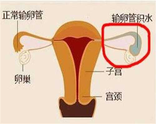 深圳代孕公司,处女膜仍在的17岁孕妇，罕见双宫